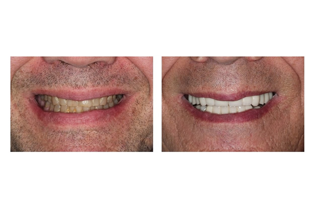 Before and After Images Dental Implants white teeth